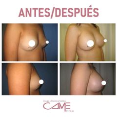 Aumento de pecho - Clínicas Came
