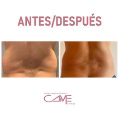 Liposucción - Clínicas Came