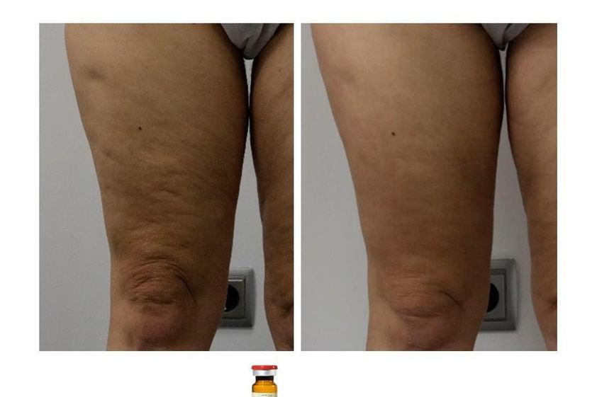 Mesoterapia antes y después - 739652