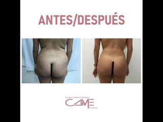 Lipoescultura