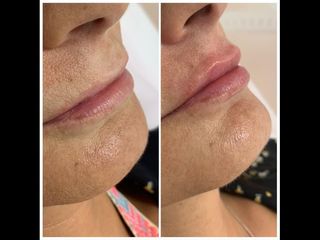 Labio con AH.jpg