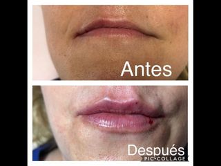 Aumento labios Ácido Hialurónico