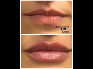 Aumento labios Ácido Hialurónico