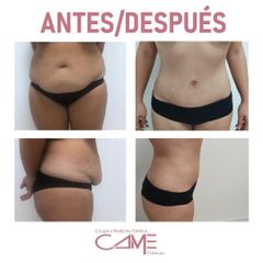 Abdominoplastia - Clínicas Came