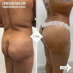 Liposucción - Clínicas Came
