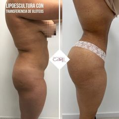 Liposucción - Clínicas Came