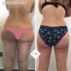 Liposucción - Clínicas Came