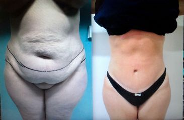 Abdominoplastia - Clínicas Came