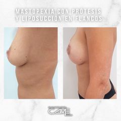 Mastopexia - Clínicas Came Alicante