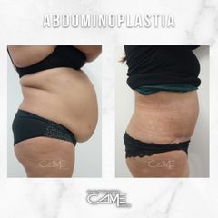 Abdominoplastia - Clínicas Came Alicante
