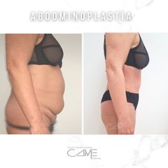 Abdominoplastia - Clínicas Came Alicante
