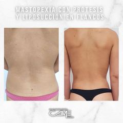 Liposucción - Clínicas Came Alicante