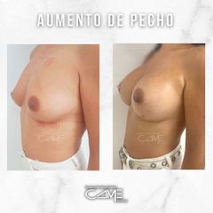 Aumento de pecho - Clínicas Came Alicante