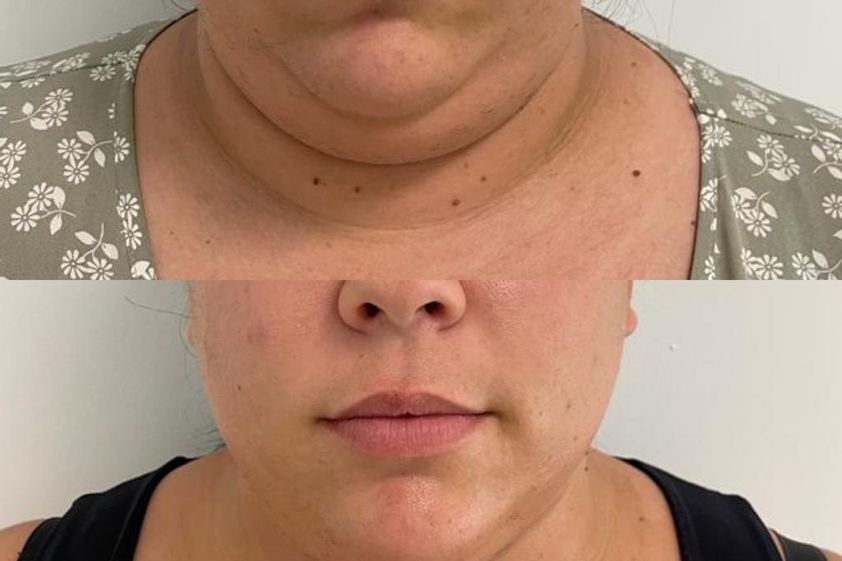 Liposucción de papada antes y después - 856788