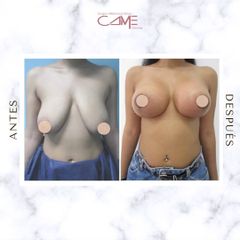 Mastopexia - Clínicas CAME