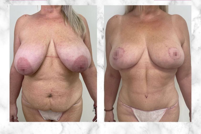 Lipoescultura antes y después - 860551
