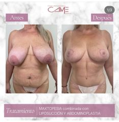Lipoescultura - Clínicas CAME