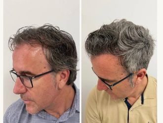 Microinjertos antes y después - 878456