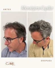 Clínicas CAME - Microinjerto Capilar