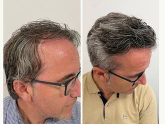 Microinjertos antes y después - 878457