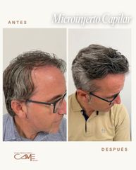 Clínicas CAME - Microinjerto Capilar