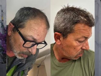 Microinjertos antes y después - 878458