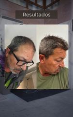 Clínicas CAME - Microinjerto Capilar