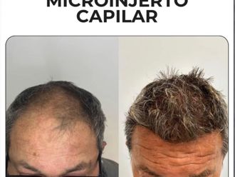Microinjertos antes y después - 878459