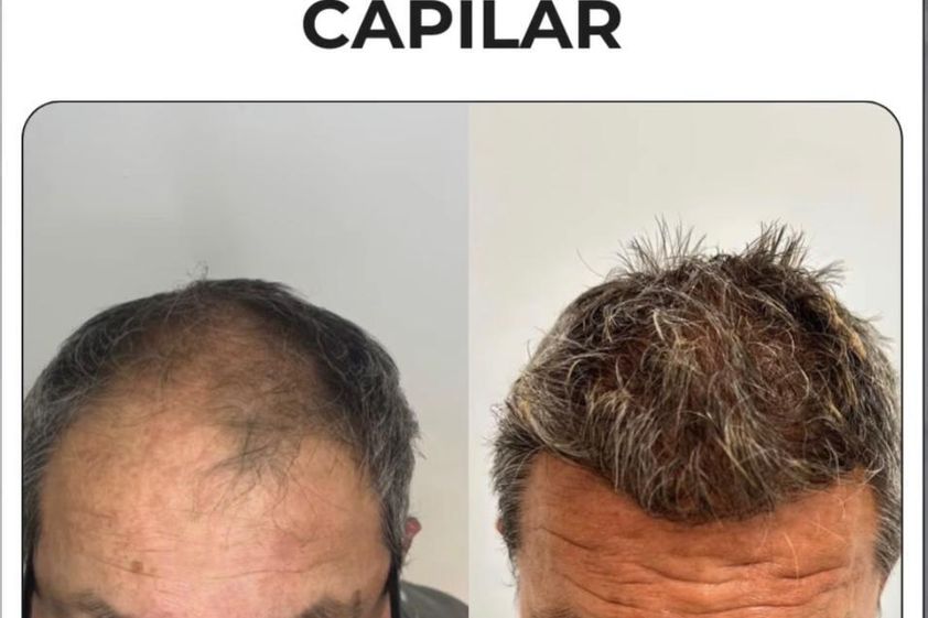 Microinjertos antes y después - 878459