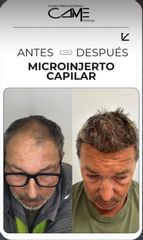 Clínicas CAME - Microinjerto Capilar