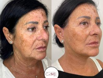 Lifting antes y después - 879464