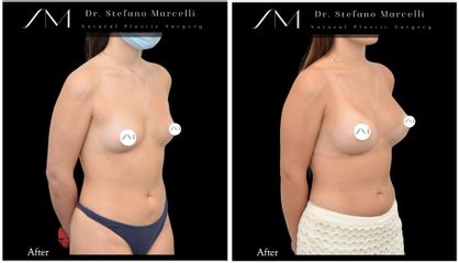 Aumento de pecho - Dr. Stefano Marcelli