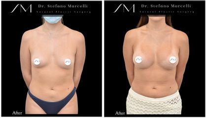 Aumento de pecho - Dr. Stefano Marcelli