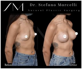 Aumento de pecho - Dr. Stefano Marcelli