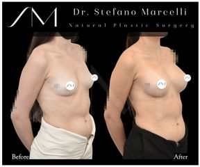 Aumento de pecho - Dr. Stefano Marcelli