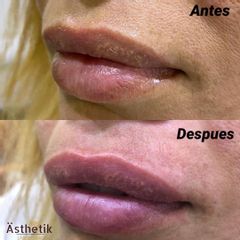 Aumento de labios - Dentalias