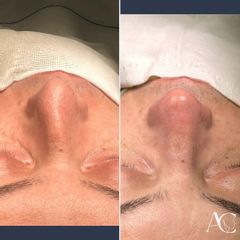 Rinoplastia - Dr. Amaro Camacho