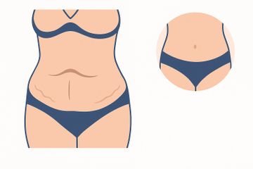 Abdominoplasita