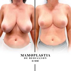 Mamoplastia de reducción - Doctor Xavier Tintoré