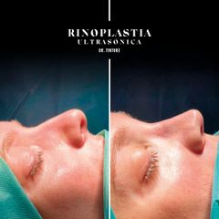 Rinoplastia- Doctor Xavier Tintoré