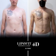Lipofit 4D - Doctor Xavier Tintoré