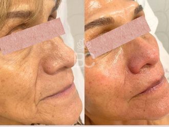 Rejuvenecimiento facial antes y después - 876883