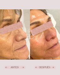 Be Classy - Rejuvenecimiento