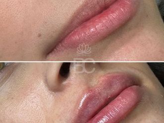 Aumento labios antes y después - 876884