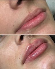 Aumento de labios
