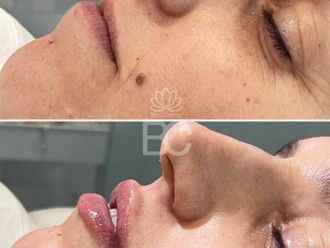 Aumento labios antes y después - 876886