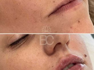 Aumento labios antes y después - 876887