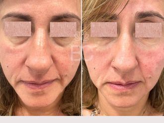 Eliminación ojeras antes y después - 876888