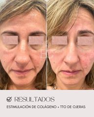 Eliminación de ojeras