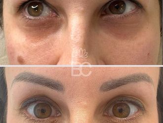Blefaroplastia antes y después - 876889